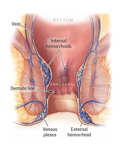  piles hemorrhoids 3